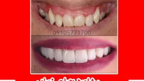 ایمپلنت ولمینت دندان در مشهد