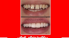 کامپوزیت دندان در مشهد