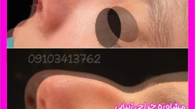 عمل زیبایی بینی