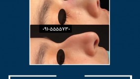 عمل  زیبایی بینی در مشهد