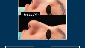 عمل  جراحی زیبایی بینی در مشهد