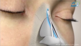 نحوه جراحی بینی عقابی