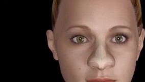 فیلم جراحی عمل بینی نوک گرد