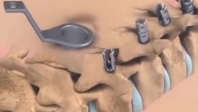 برای نخستین بار در تاریخ ؛ درمان قطعی قطع نخاع توسط کره جنوبی