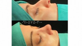 عمل بینی به روش بسته و باز