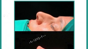 فیلم جراحی بینی در مشهد