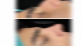 جراحی بینی طبیعی و فانتزی