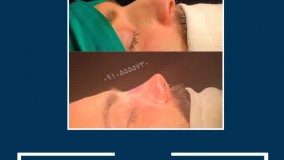 عمل  زیبایی بینی در مشهد