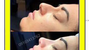 جراحی زیبایی بینی  در مشهد