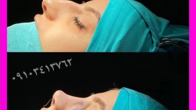 فیلم عمل بینی در مشهد