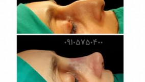 عکس جراحی زیبایی بینی مشهد