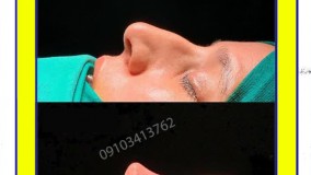 نمونه عمل بینی  استخوانی