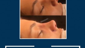 فیلم عمل بینی در مشهد