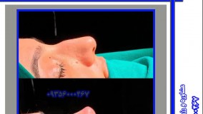 فیلم عمل بینی در مشهد