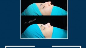 فیلم عمل بینی در مشهد