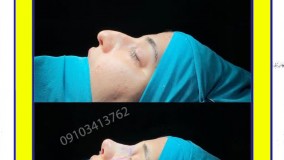 نمونه عمل بینی گوشتی