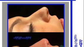 نمونه عمل بینی  استخوانی