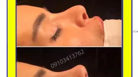 نمونه عمل قبل وبعد بینی مشهد
