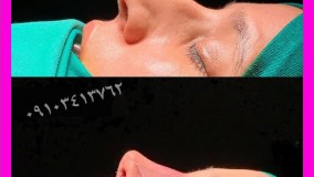 فیلم عمل زیبایی بینی