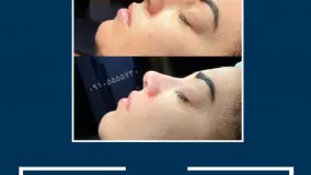 عمل  زیبایی بینی در مشهد