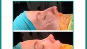 فیلم عمل بینی در مشهد