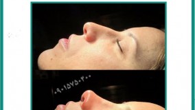 رینوپلاستی در مشهد