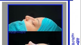 رینوپلاستی در مشهد