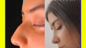 بهترین عمل بینی گوشتی مشهد