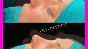 فیلم عمل بینی در مشهد