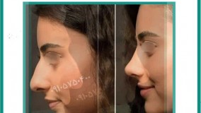 برترین عمل بینی در مشهد