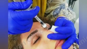 تزریق فیلر به بینی توسط خانم دکتر ناهید همتیان درکلینیک تخصصی جُوان