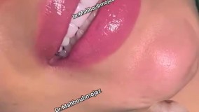 تزریق ژل لب مدل روسی