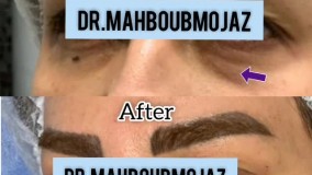 فیلر زیر چشم