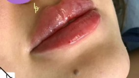 فیلر لب روسی