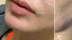 تزریق زاویه فک و چانه