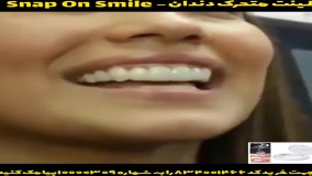 خرید لمینت متحرک دندان اسنپ آن اسمایل-09363660478