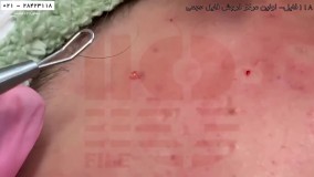 پاکسازی و لایه برداری پوست-درمارولر صورت-برداشتن جوش و آکنه