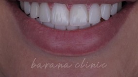 قبل و بعد کامپوزیت دندان در کلینیک دندانپزشکی بارانا