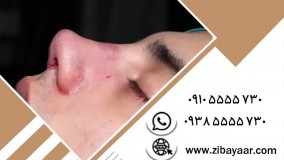 هزینه جراحی زیبایی بینی استخوانی در مشهد