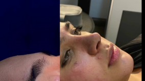 جراحی زیبایی بینی