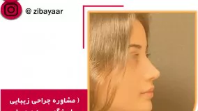 جراحی زیبایی بینی عروسکی در تهران