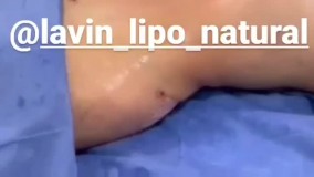 نی نی بان - کلینیک زیبایی لاوین لیپو