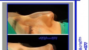 جراحی بینی استخوانی در کرمان