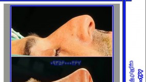 جراحی بینی استخوانی در بندر عباس