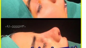 بینی فانتزی در رشت