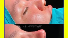 جراحی بینی طبیعی در بندر عباس