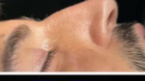 جراحی بینی طبیعی در کرمان