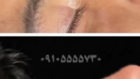 جراحی بینی غضروفی در رشت