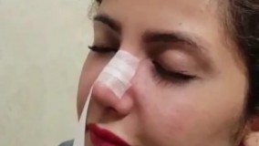 آموزش چسب زدن اصولی بینی عمل شده ، دکتر حمید ملکان راد، نگین  گرگان