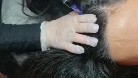 مزوتراپی مو